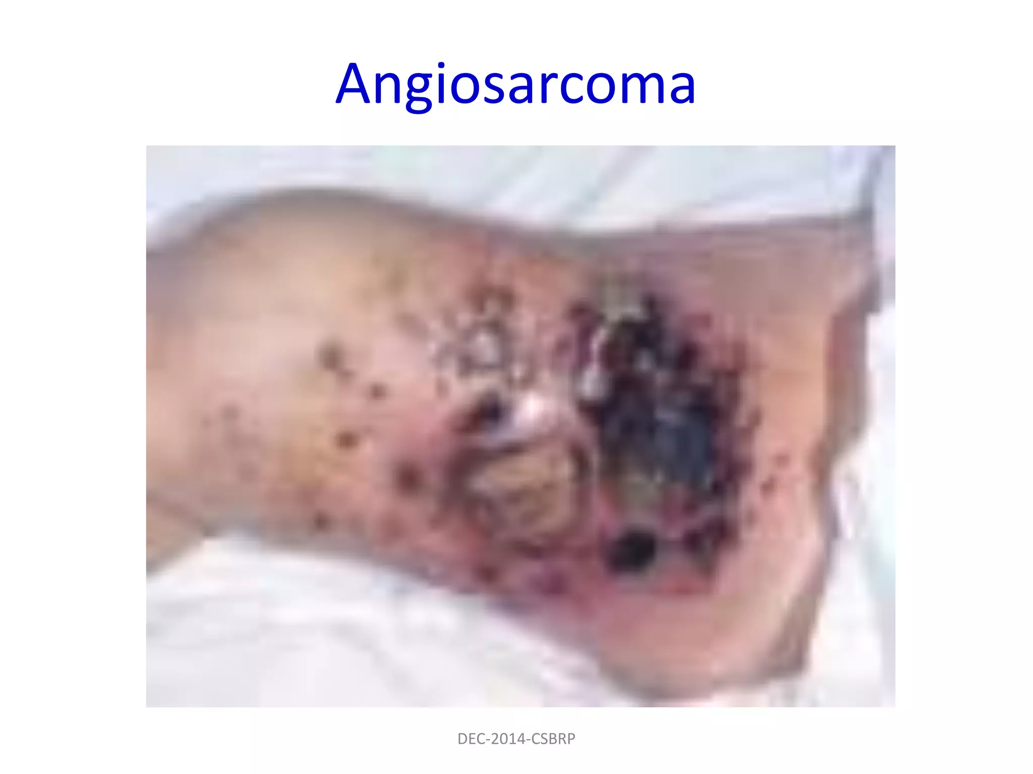 Angiosarcoma
DEC-2014-CSBRP
 