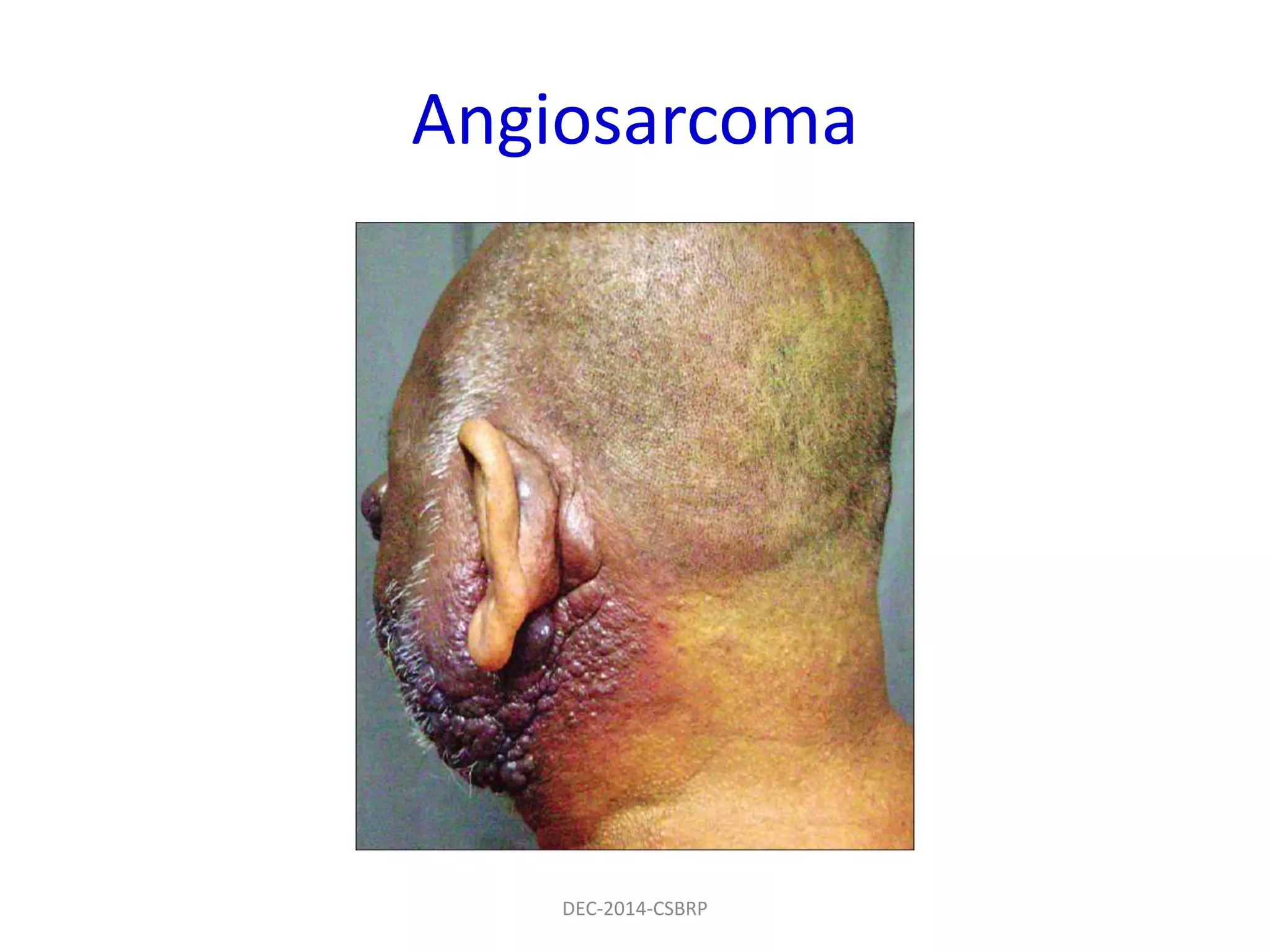 Angiosarcoma
DEC-2014-CSBRP
 