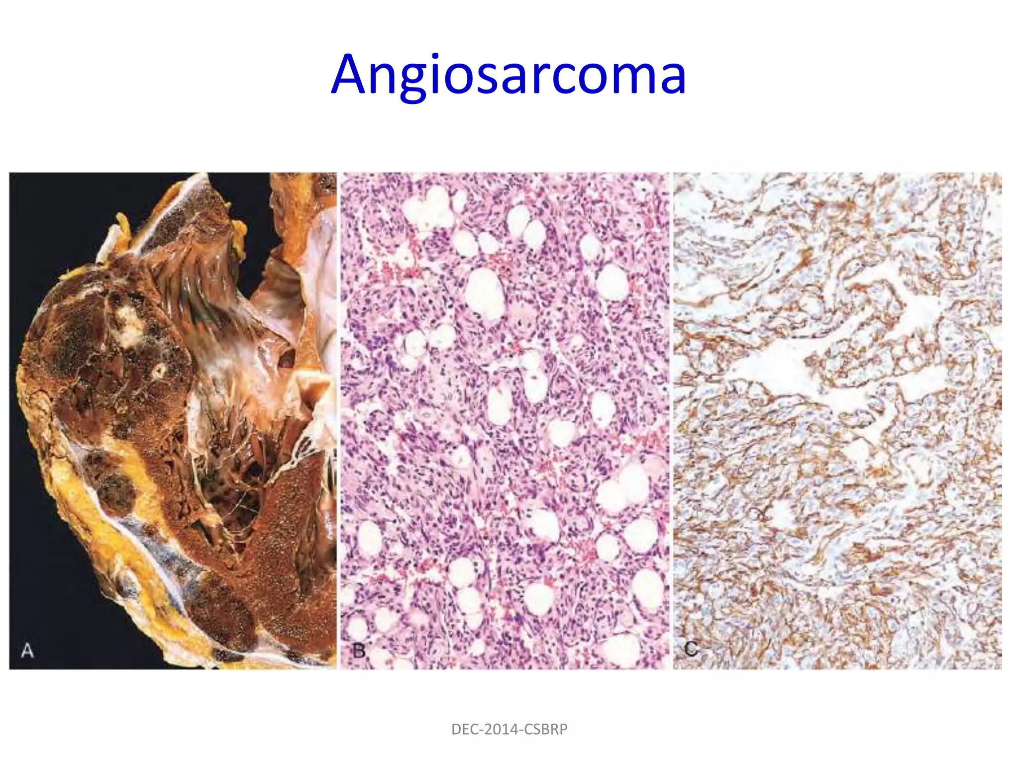 Angiosarcoma
DEC-2014-CSBRP
 