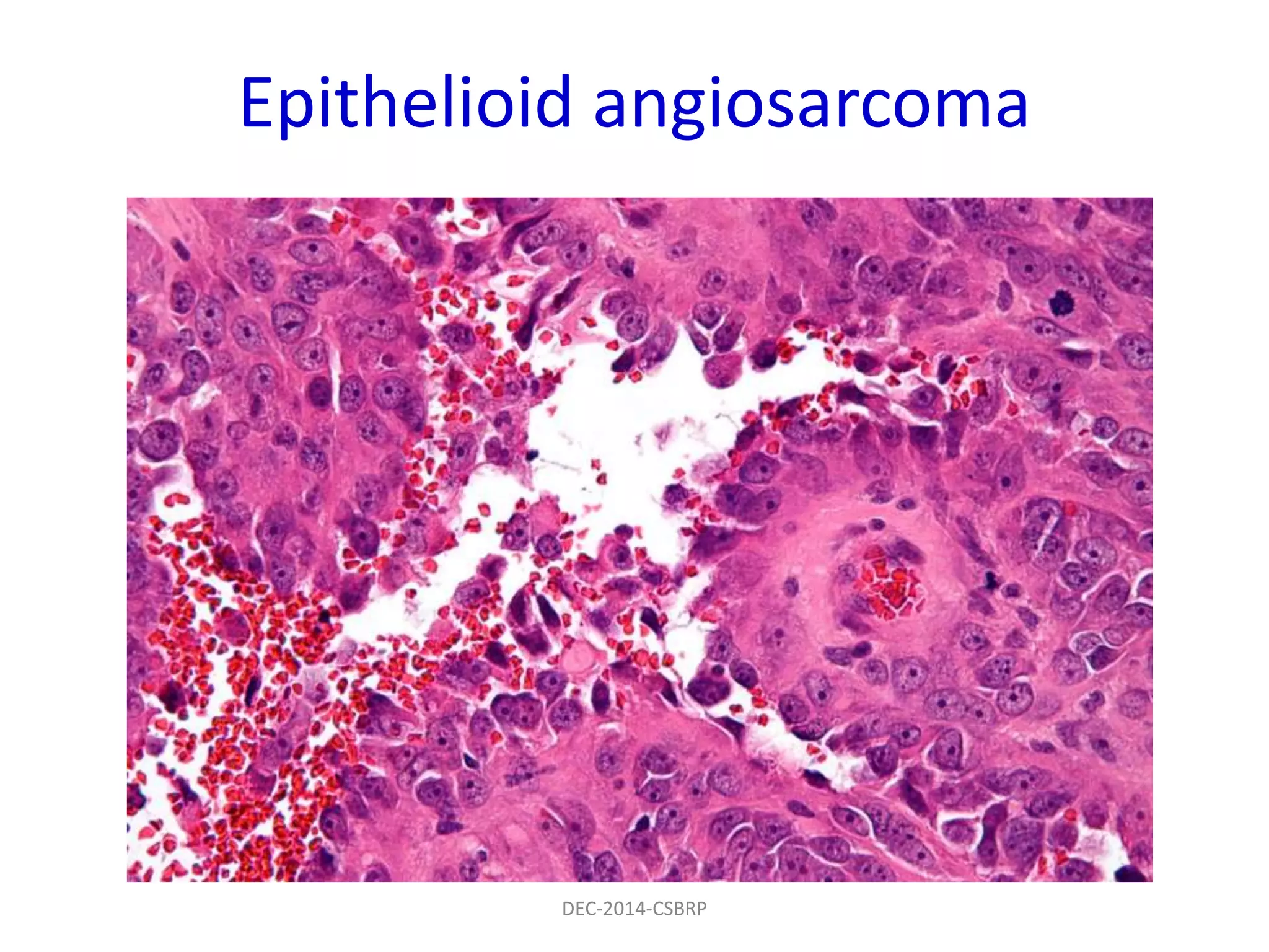 Epithelioid angiosarcoma
DEC-2014-CSBRP
 