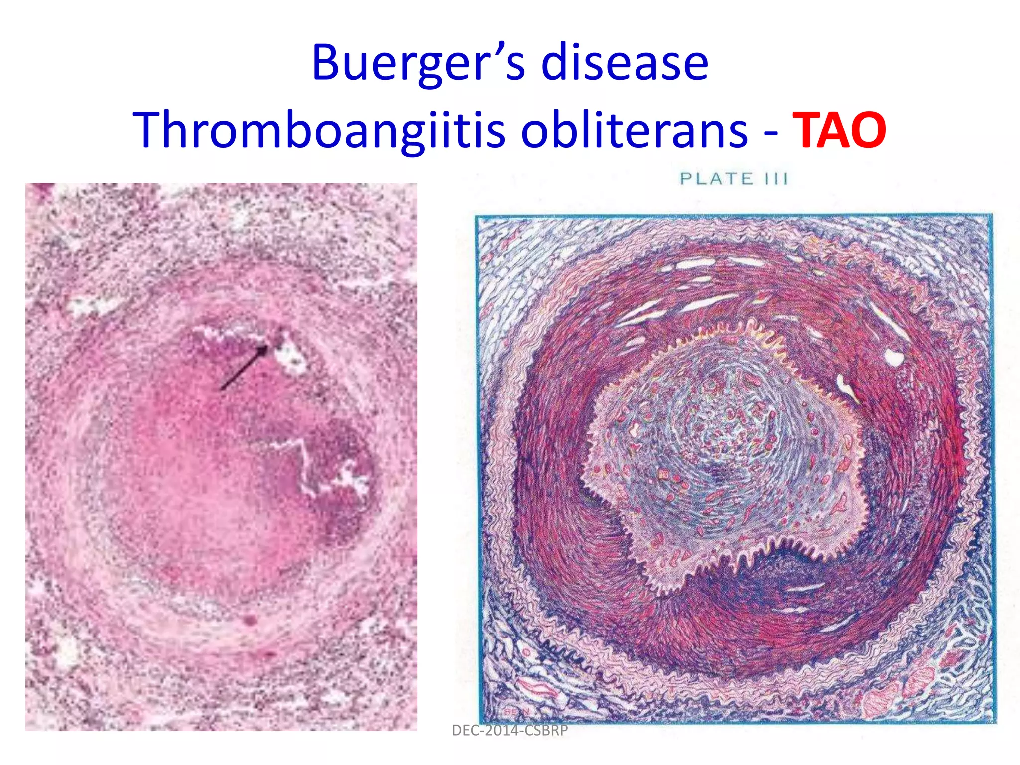 Buerger’s disease
Thromboangiitis obliterans - TAO
DEC-2014-CSBRP
 