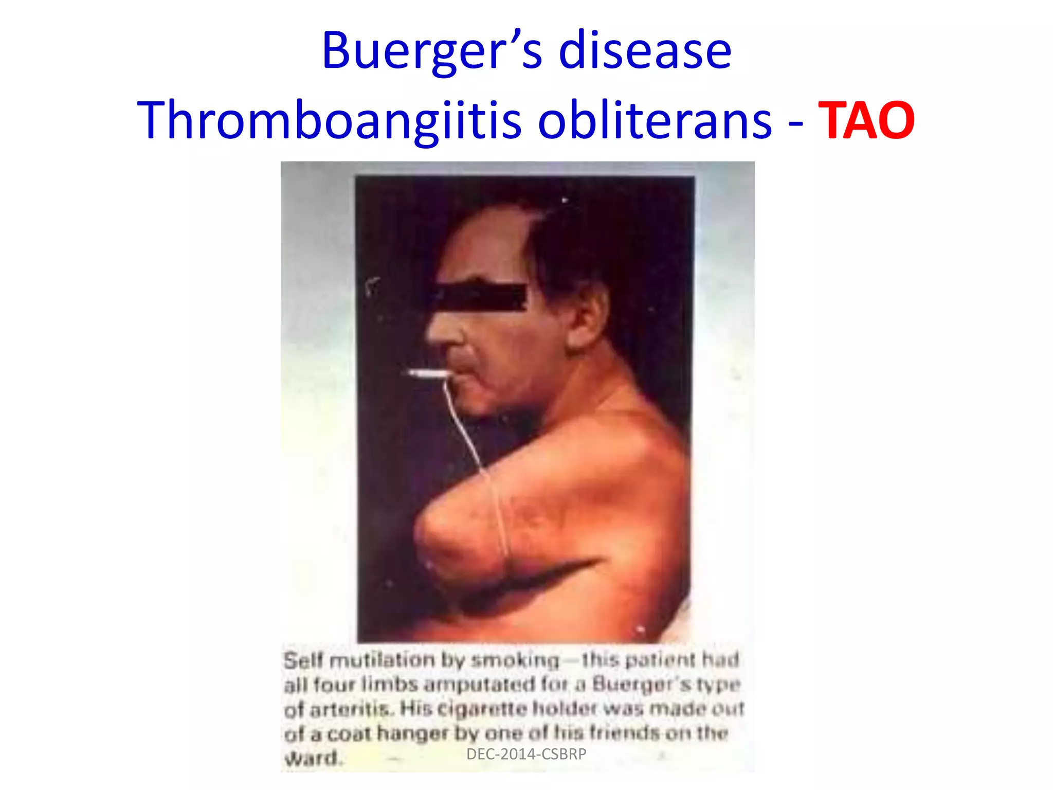 Buerger’s disease
Thromboangiitis obliterans - TAO
DEC-2014-CSBRP
 