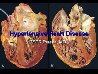 Hypertensive Heart DiseaseHypertensive Heart Disease
CSBR.Prasad, MD.,CSBR.Prasad, MD.,
May-2015-CSBRP 1
 