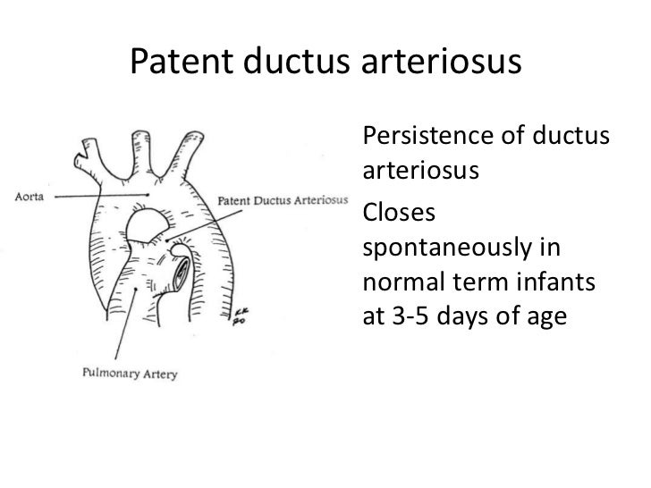 Patent Ductus Arteriosus