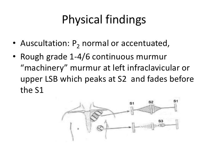 Patent Ductus Arteriosus