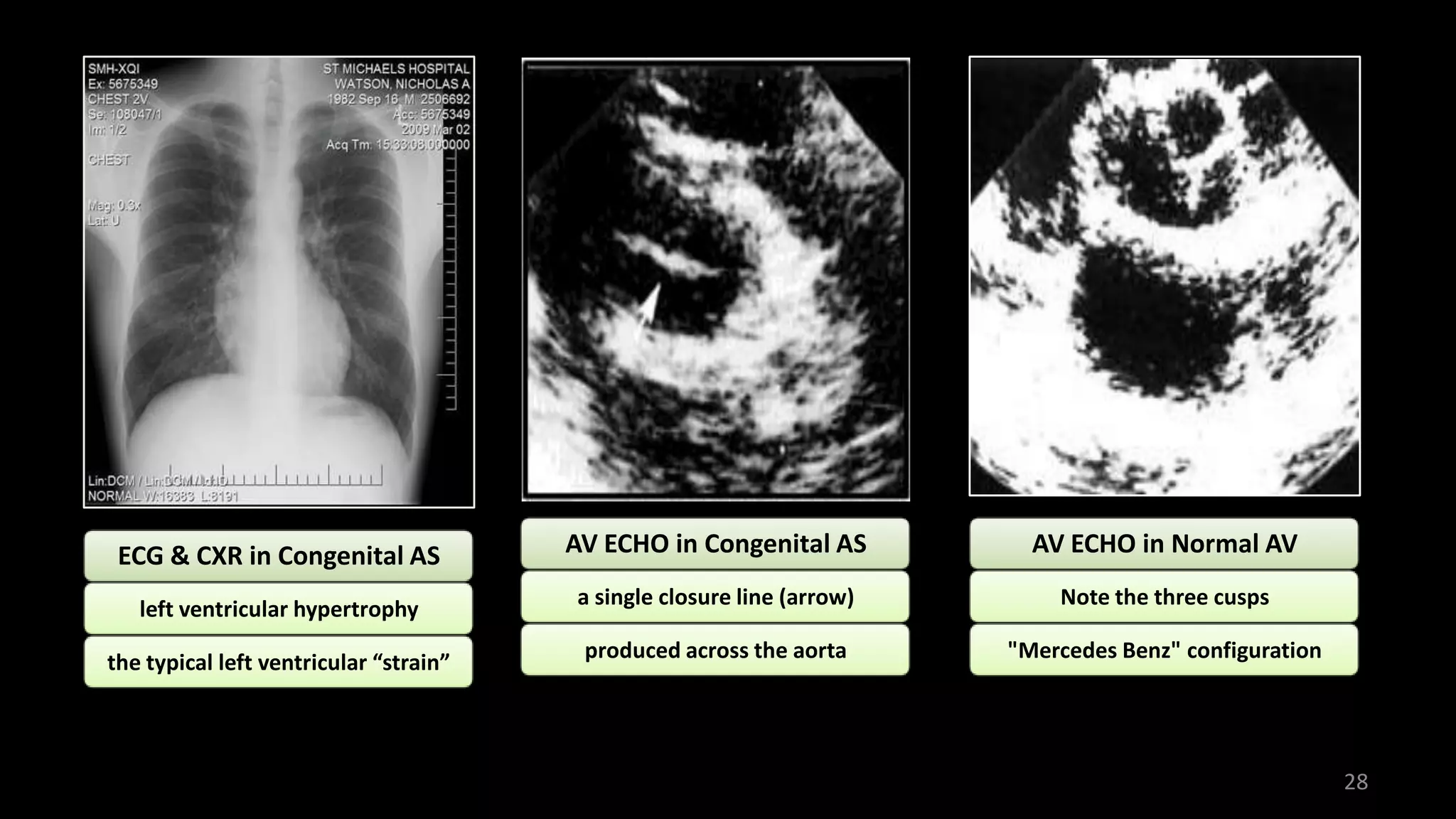 Cvs Simple Approach To Chd | PPT
