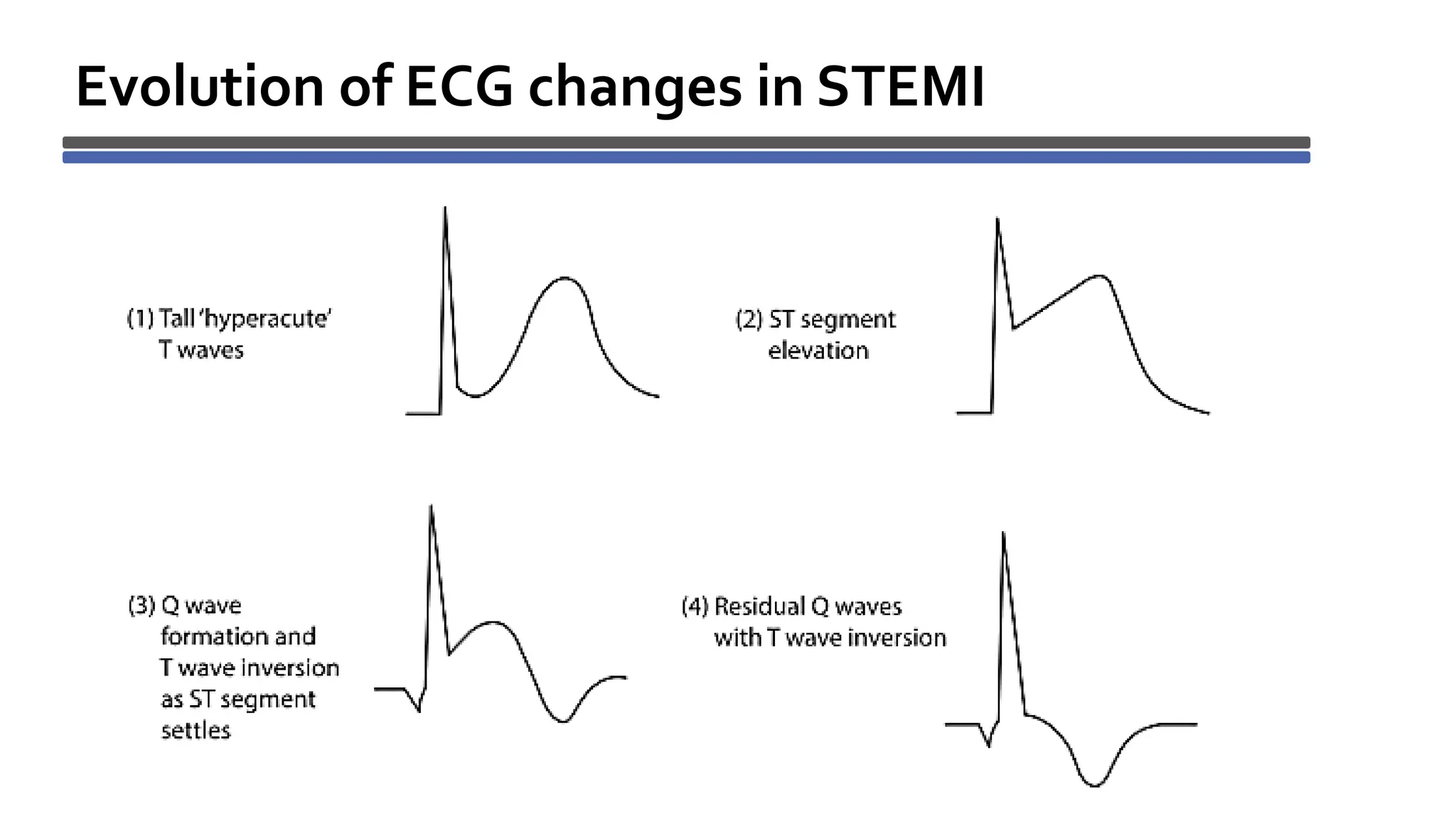 Evolution of ECG changes in STEMI
 