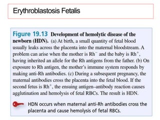 Erythroblastosis Fetalis
 