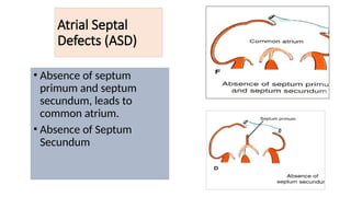 Atrial Septal
Defects (ASD)
• Absence of septum
primum and septum
secundum, leads to
common atrium.
• Absence of Septum
Secundum
 