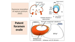 Excessive resorption
of septum primum
(ASD)
Patent
foramen
ovale
(ASD)
 