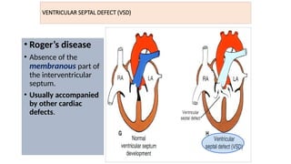 VENTRICULAR SEPTAL DEFECT (VSD)
• Roger’s disease
• Absence of the
membranous part of
the interventricular
septum.
• Usually accompanied
by other cardiac
defects.
 