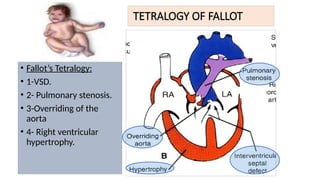 TETRALOGY OF FALLOT
• Fallot’s Tetralogy:
• 1-VSD.
• 2- Pulmonary stenosis.
• 3-Overriding of the
aorta
• 4- Right ventricular
hypertrophy.
 