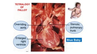 TETRALOGY
OF
FALLOT
Blue Baby
 