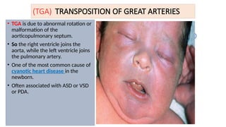 (TGA) TRANSPOSITION OF GREAT ARTERIES
• TGA is due to abnormal rotation or
malformation of the
aorticopulmonary septum.
• So the right ventricle joins the
aorta, while the left ventricle joins
the pulmonary artery.
• One of the most common cause of
cyanotic heart disease in the
newborn.
• Often associated with ASD or VSD
or PDA. Blue
Baby
 