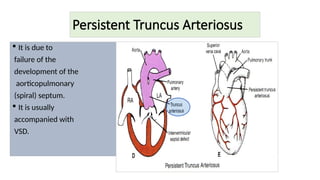 Persistent Truncus Arteriosus
 It is due to
failure of the
development of the
aorticopulmonary
(spiral) septum.
 It is usually
accompanied with
VSD.
 