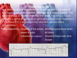 Pulsus Bigeminus Coupling of the pulses
waves in pairs
Followed by a pause
Alternate premature beats
AV block
Sinoatrial block with Vent.
Escape
Pulsus bigeminus
is a cardiovascular phenomenon characterized by groups of
two heartbeats close together followed by a longer pause. The
second pulse is weaker than the first beat. The smaller beat is
palpated as either a missing or an extra beat, and on EKG resembles a
PVC. These PVCs appearing every other beat are also called
extrasystoles.
 