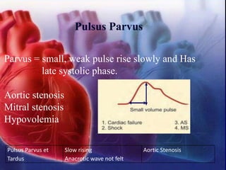 Pulsus Parvus
Parvus = small, weak pulse rise slowly and Has
late systolic phase.
Aortic stenosis
Mitral stenosis
Hypovolemia
Pulsus Parvus et
Tardus
Slow rising
Anacrotic wave not felt
Aortic Stenosis
 
