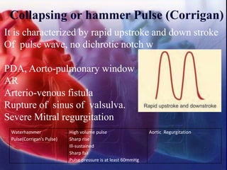 Collapsing or hammer Pulse (Corrigan)
It is characterized by rapid upstroke and down stroke
Of pulse wave, no dichrotic notch w
PDA, Aorto-pulmonary window
AR
Arterio-venous fistula
Rupture of sinus of valsulva.
Severe Mitral regurgitation
Waterhammer
Pulse(Corrigan’s Pulse)
High volume pulse
Sharp rise
Ill-sustained
Sharp fall
Pulse pressure is at least 60mmHg
Aortic Regurgitation
 