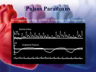 Pulsus Paradoxus
An exaggerated drop in SBP (>10mmHg) with inspiration
 