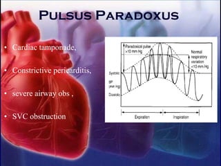 Pulsus Paradoxus
• Cardiac tamponade,
• Constrictive pericarditis,
• severe airway obs ,
• SVC obstruction
 