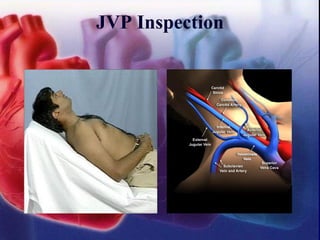 JVP Inspection
 