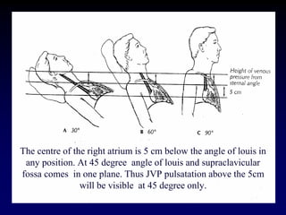 The centre of the right atrium is 5 cm below the angle of louis in
any position. At 45 degree angle of louis and supraclavicular
fossa comes in one plane. Thus JVP pulsatation above the 5cm
will be visible at 45 degree only.
 