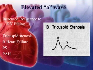 Elevated “a” wave
Increased Resistance to
RV Filling.
Tricuspid stenosis
R Heart Failure
PS
PAH
 