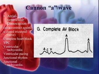 Cannon “a” wave
• Atrial-
ventricular
Dissociation
(atria contract against
a closed tricuspid
valve)
Complete heart block
VPC
Ventricular
tachycardia
Ventricular pacing
Junctional rhythm
Junctional
tachycardia.
 