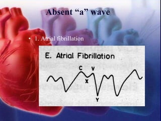 Absent “a” wave
• 1. Atrial fibrillation
 