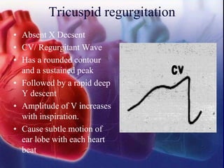 Tricuspid regurgitation
• Absent X Decsent
• CV/ Regurgitant Wave
• Has a rounded contour
and a sustained peak
• Followed by a rapid deep
Y descent
• Amplitude of V increases
with inspiration.
• Cause subtle motion of
ear lobe with each heart
beat
 
