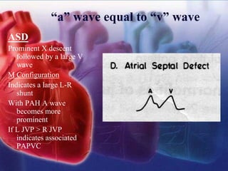 “a” wave equal to “v” wave
ASD
Prominent X descent
followed by a large V
wave
M Configuration
Indicates a large L-R
shunt
With PAH A wave
becomes more
prominent
If L JVP > R JVP
indicates associated
PAPVC
 