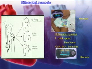 Differential cyanosis
1. pink upper,
blue lower
CoA, IAA, Pulm Htn
Blue lower
Pink Upper Pink Upper
 