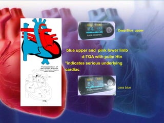 blue upper and pink lower limb
d-TGA with pulm Htn
*indicates serious underlying
cardiac
Deep Blue upper
Less blue
 