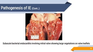 Pathogenesis of IE (Cont..)
10
Subacute bacterial endocarditis involving mitral valve showing large vegetations on valve leaflets
 