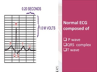 Normal ECG
composed of
❑ P wave
❑QRS complex
❑T wave
 