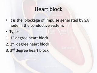 Heart block
• It is the blockage of impulse generated by SA
node in the conductive system.
• Types:
1. 1st degree heart block
2. 2nd degree heart block
3. 3rd degree heart block
 