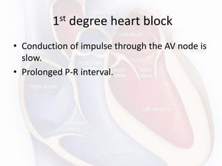 1st degree heart block
• Conduction of impulse through the AV node is
slow.
• Prolonged P-R interval.
 