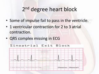 2nd degree heart block
• Some of impulse fail to pass in the ventricle.
• 1 ventricular contraction for 2 to 3 atrial
contraction.
• QRS complex missing in ECG
 