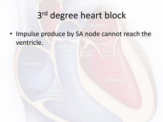 3rd degree heart block
• Impulse produce by SA node cannot reach the
ventricle.
 