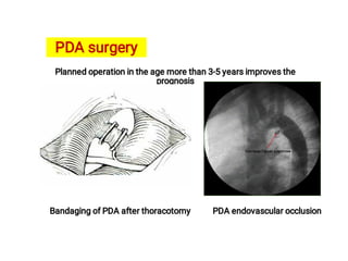 Pda Suregery Cardiovascular System (pediatrics) | PDF