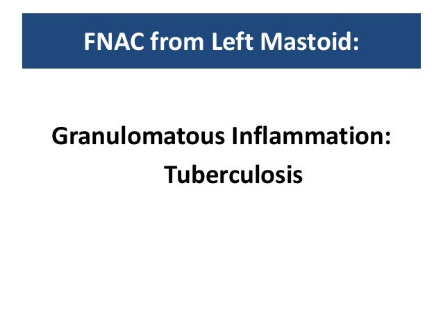 Cerebral Venous Sinus Thrombosis (CVST) Case Report