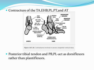  Contracture of the TA,EHB,PL,PT,and AT
 Posterior tibial tendon and PB,PL-act as dorsiflexors
rather than plantiflexors.
 