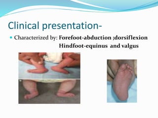 Clinical presentation-
 Characterized by: Forefoot-abduction ;dorsiflexion
Hindfoot-equinus and valgus
 