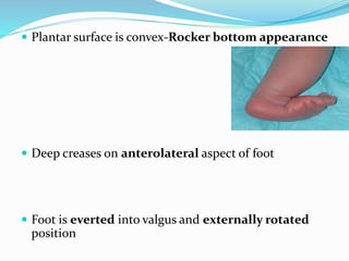  Plantar surface is convex-Rocker bottom appearance
 Deep creases on anterolateral aspect of foot
 Foot is everted into valgus and externally rotated
position
 