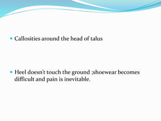  Callosities around the head of talus
 Heel doesn’t touch the ground ;shoewear becomes
difficult and pain is inevitable.
 