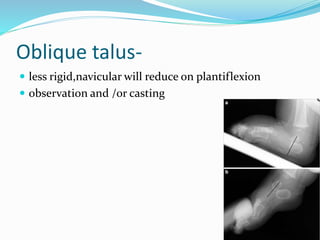 Oblique talus-
 less rigid,navicular will reduce on plantiflexion
 observation and /or casting
 