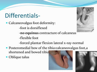 Differentials-
 Calcaneovalgus foot deformity:
-foot is dorsiflexed
-no equinus contracture of calcaneus
-flexible foot
-forced plantar flexion lateral x-ray-normal
 Posteromedial bow of the tibia:calcaneovalgus foot,a
shortened and bowed tibia
 Oblique talus
 