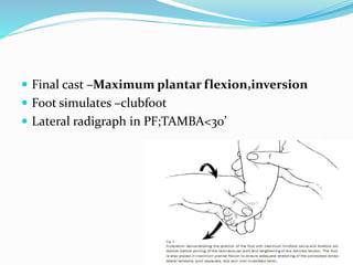  Final cast –Maximum plantar flexion,inversion
 Foot simulates –clubfoot
 Lateral radigraph in PF;TAMBA<30’
 