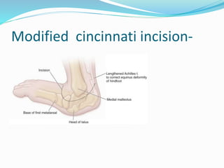Modified cincinnati incision-
 