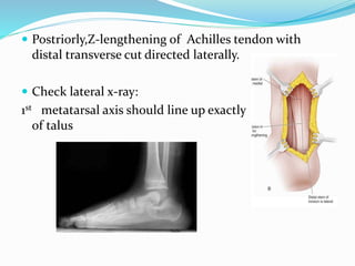  Postriorly,Z-lengthening of Achilles tendon with
distal transverse cut directed laterally.
 Check lateral x-ray:
1st metatarsal axis should line up exactly with long axis
of talus
 